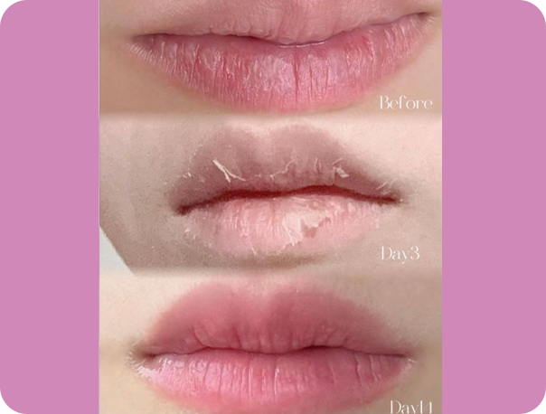 1度の施術でも効果が期待できる