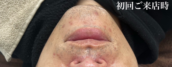 ハーブピーリング ギャラリー