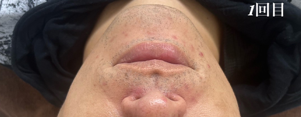 ハーブピーリング ギャラリー