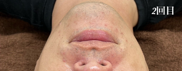 ハーブピーリング ギャラリー