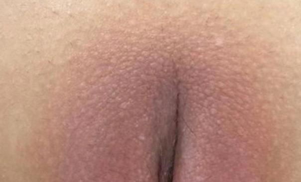 ローマピンク ギャラリー